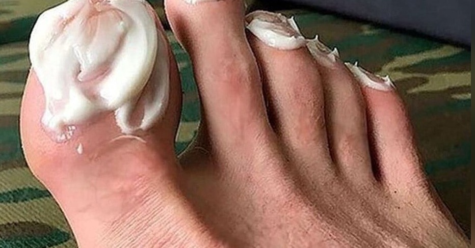 Here's How You Can Get Rid Of Toenail Fungus Overnight